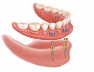 Douglas Rodney Couvillon Precision-Fit Dentures: Three Options Tissue-Supported Tissue-supported dentures are removable dental devices to replace your natural teeth.