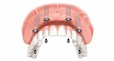 Wearers remove the dentures to clean them. The implants give the dentures structural support and stability, and dramatically reduce bone loss over time.