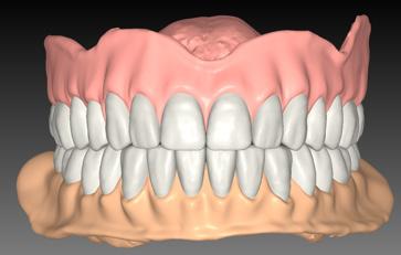 Case Report: Refining and Designing At the try-in appointment, a pickup impression of the lower partial was taken, such that the laboratory could raise the lower right teeth on the partial to match