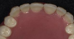 The functional prototype was sent to the laboratory for evaluation and delivery to the clinician (Figure 3). This hybrid offering is unique within the digital denture category.