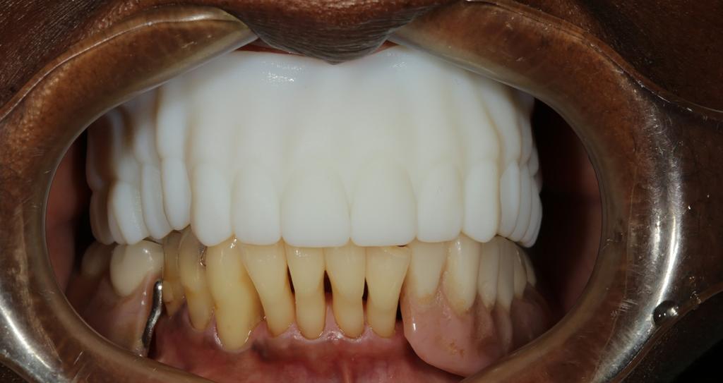 The maxillary and mandibular trays (or bite plane) were secured together with bite registration material in the Centric Relation position (Figure 3).