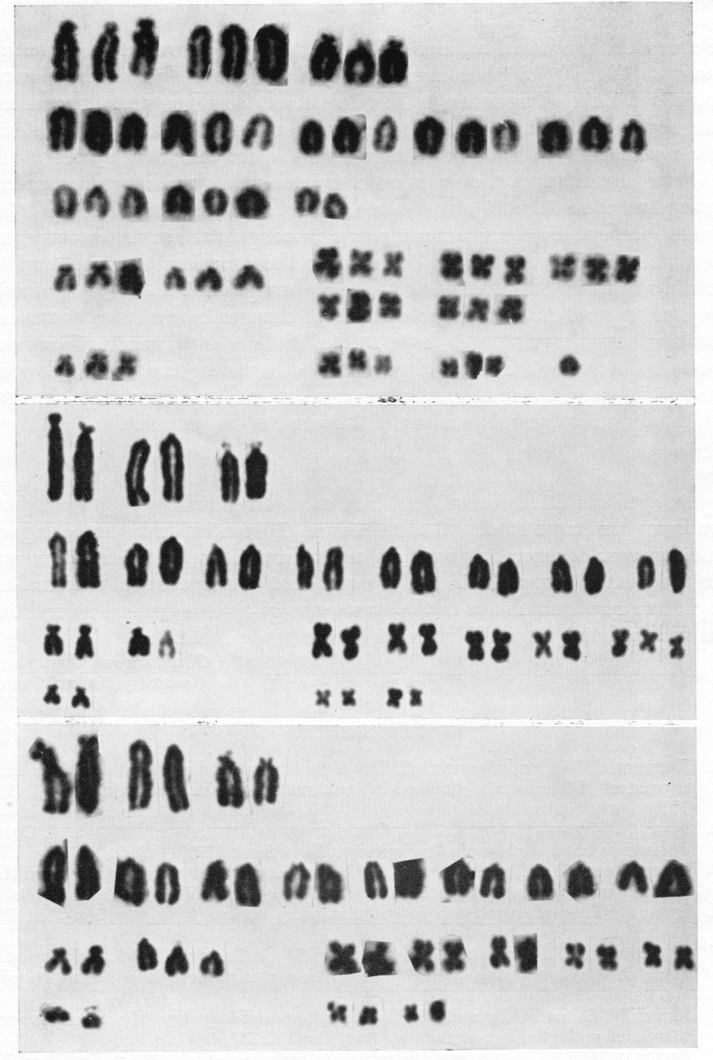 Triploid condition with XXY sex chromosomes. Fig. 3 (center).