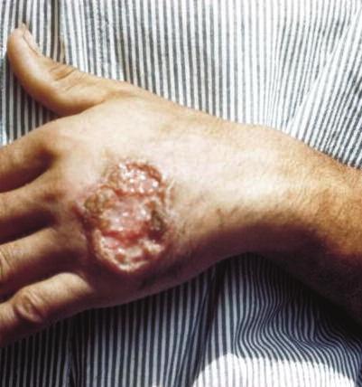 3. Disease characteristics of leishmaniasis Most people infected with Leishmania do not develop the disease. In Europe, there are two main forms of leishmaniasis. Fig. 3.