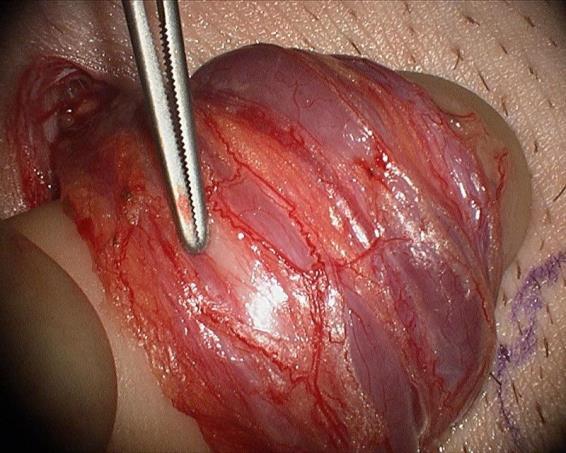Varicocelectomy Subinguinal