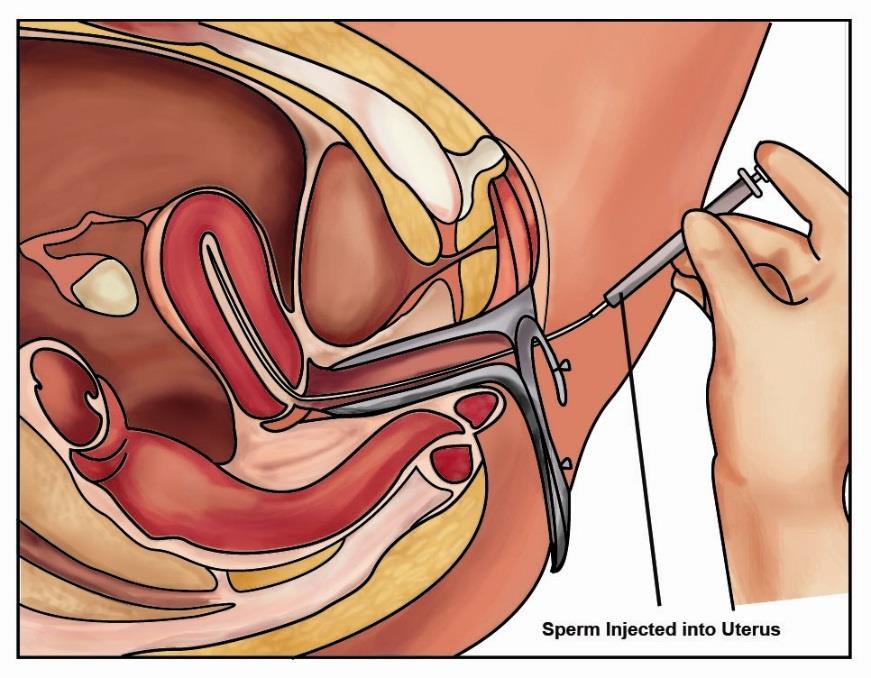 ART: Intrauterine insemination (IUI) 10 million motile sperm pre-wash 3ml 9M/ml 45%