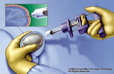 Sperm aspiration: TESA Testicular sperm aspiration Anesthetic depends on technique FNA True cut needle Needle gun (ouch!