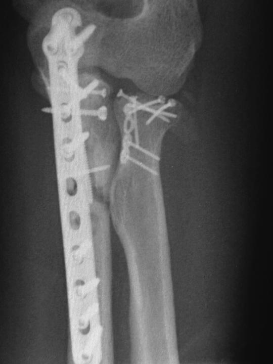 Details of the type II Monteggia fractures with associated posterior ulnohumeral dislocation Classifications Case Side of Gender/ age (yrs)* Dominance injury Mechanism Bado7