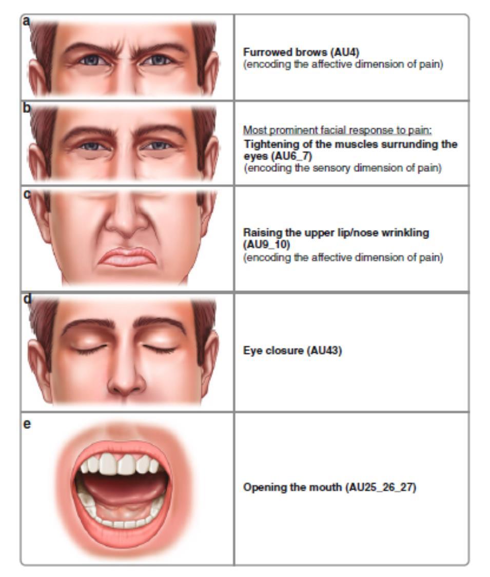 Patterns of Pain Facial Expressions Pattern I: tightening of the muscles surrounding the eyes with furrowed brows and wrinkled nose (a + b + c) Pattern II: furrowed