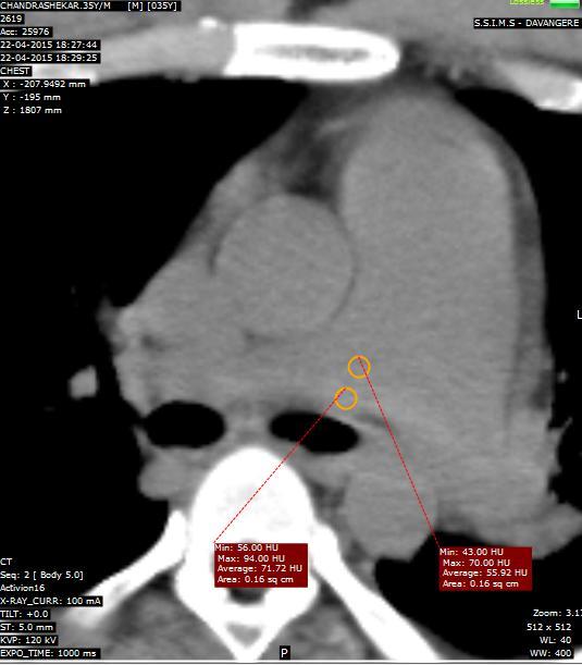 CTPA images. Fig 4:A.