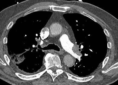 Imaging findings at CT Filling defects in pulmonary