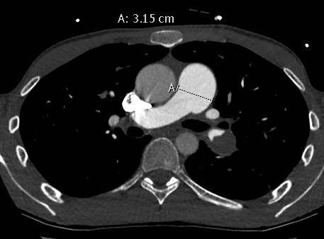 Right ventricular strain Dilated pulmonary trunk >30 mm or larger than the ascending