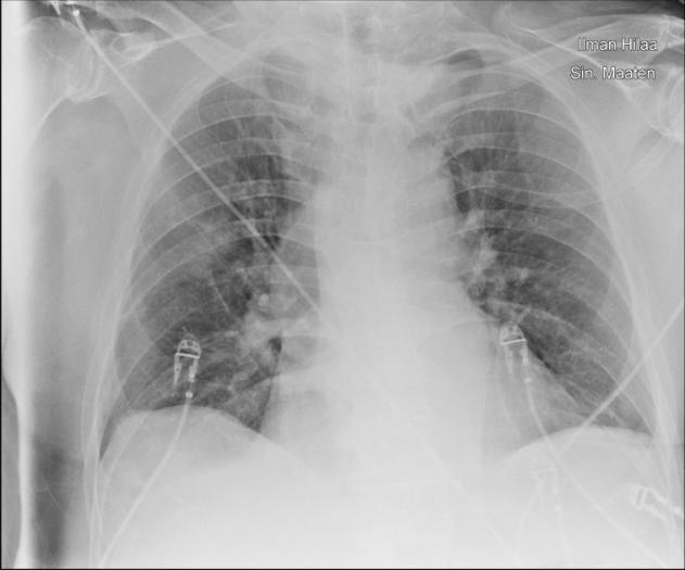 Chest radiograph Cannot be used to diagnose or rule