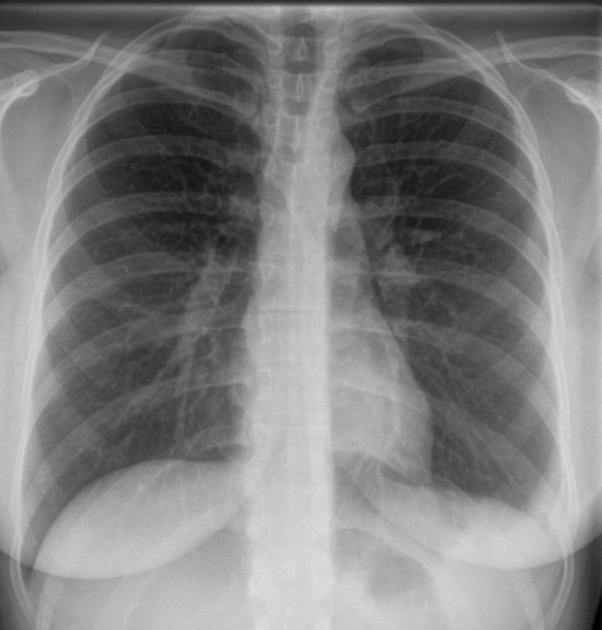 Sometimes secondary findings of PE visible pulmonary