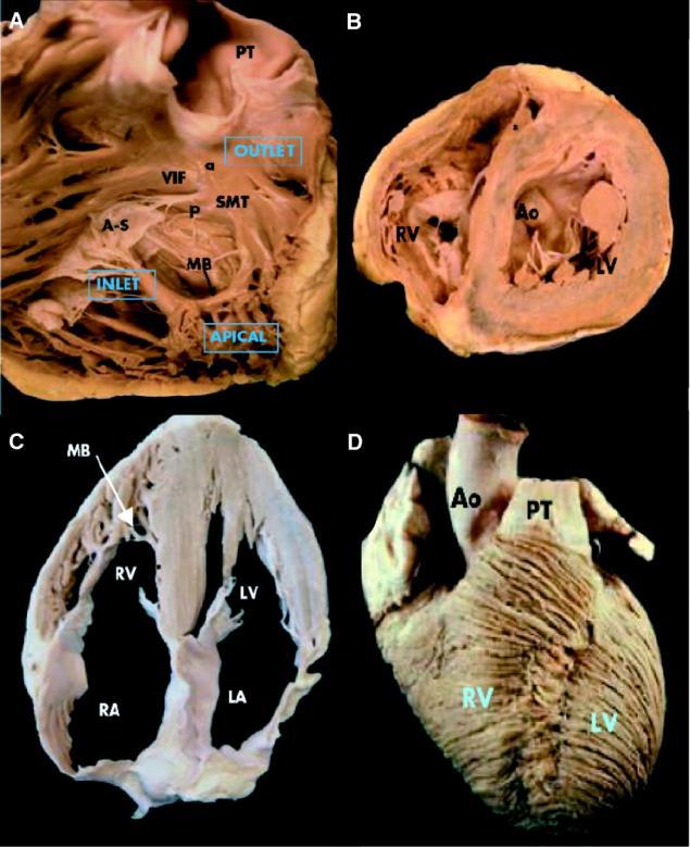Right Ventricular Anatomy The inlet, trabeculated apical myocardium and infundibulum of the RV.