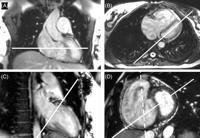 Cardiac MRI Quantify RV size, mass, function, viability, and