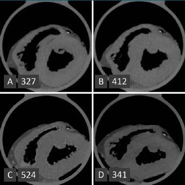 Coronary Artery Calcification Scoring with State of-the-art CT Scanners from Different Vendors has Substantial Effect on Risk of Classification Example CT images of the same heart with