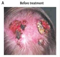 Hedgehog pathway inhibitor in basal cell carcinoma Phase I efficacy data RG3616 is efficacious in treating advanced basal