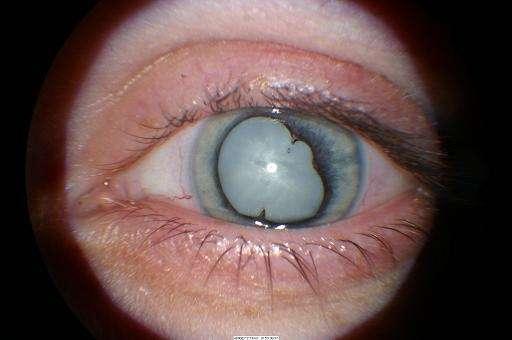 Total cataract after