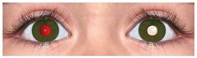 Leucocoria (white pupil):