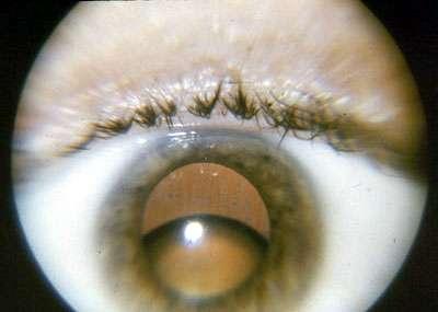 upward subluxation and cataract formation in