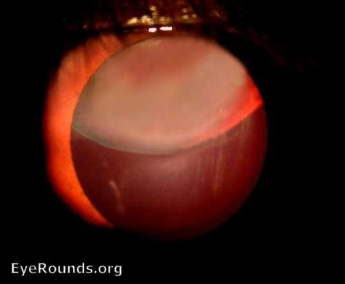 downward subluxation and cataract formation: in
