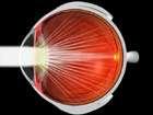 Symptoms of cataract slowly decreasing visual acuity blurring vision dimming and fading of colors poor/bad night vision visual problems in