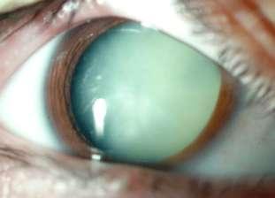Secondary findings of cataract =complications of cataract secondary glaucoma: angle closure due to swelling of the phacolytic glaucoma and lens