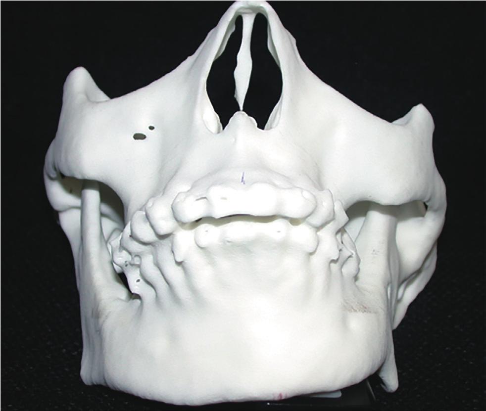 A clinical examination indicated the presence of mandibular deviation to the left side, maxillomandibular deviation to the left side, occlusal tilting, and a bird-like facial appearance due to the