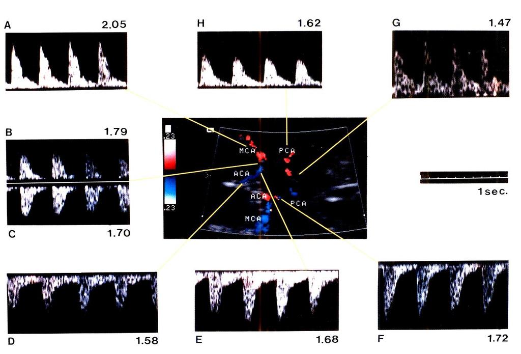 Waveforms of the Circle of Willis Doppler waveforms obtained in the same fetus at: A, middle cerebral artery; B and C, middle cerebral artery and anterior cerebral artery at their origin from the