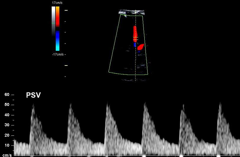 Middle Cerebral Artery Peak Systolic Velocity The middle cerebral artery can be easily sampled with an angle of 0, and the true velocity of the blood flow can be obtained.