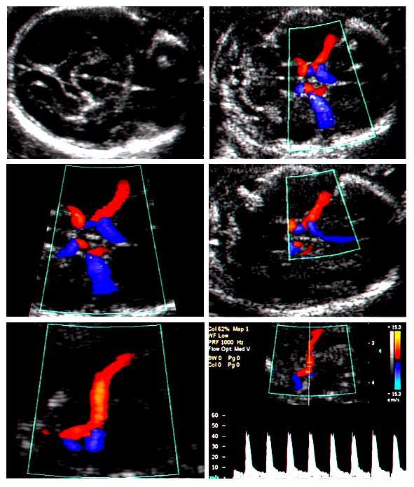 A C E B D F Middle Cerebral Artery Peak Systolic Velocity Steps for the correct sampling of middle cerebral artery peak systolic velocity.