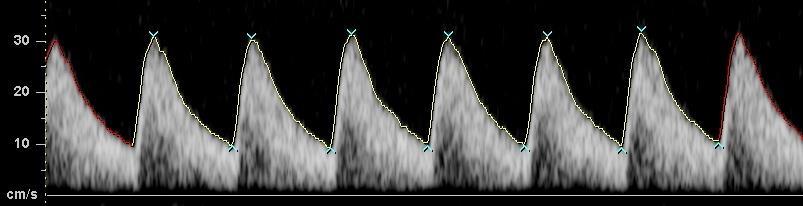 The Doppler shift arrives to the transducer. The information is analyzed, and it is presented as waveforms.