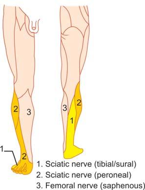 In the proximal part of popliteal fossa it runs lateral to the popliteal artery and vein but more distally its tibial branch can be found immediately above the vessels.