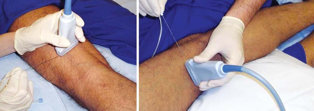 Needles and technique: A 50 to 100 mm peripheral nerve block needles; both in-plane and out-of-plane techniques 4 can be used but we recommend the in-plane technique.