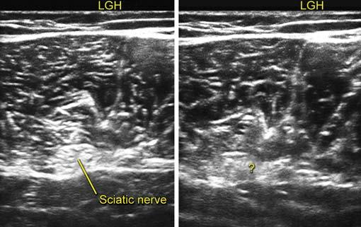 IJPUT Ultrasound-guided Sciatic Nerve Blocks: Higher and Popliteal Approaches Fig.