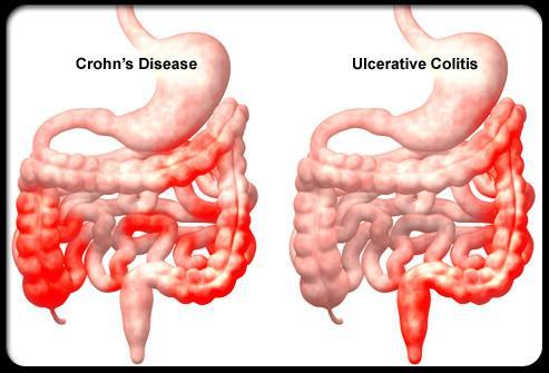 Slide 1 CROHN S DISEASE AND ULCERATIVE COLITIS Slide 2 Slide 3 Crohn s Inflammation in the GI tract but usually in the lower part of the small intestines and the colon.