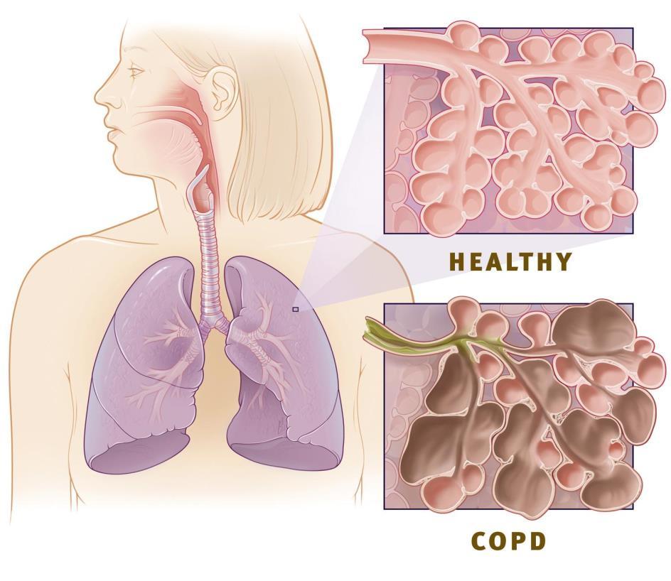 How Does COPD