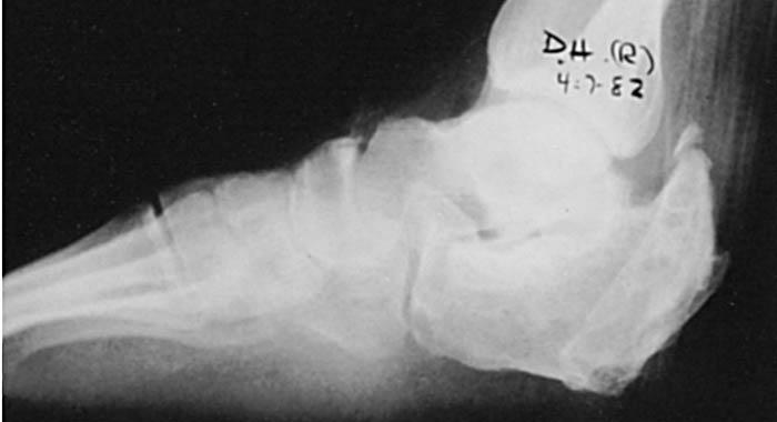 IIIb Calcaneum Type 3b changes not in joint It occurs through fracture calcaneum Short immobilisation and modified footwear Eichenholtz 3 stages I Acute II Proliferative III Consolidation Warm;