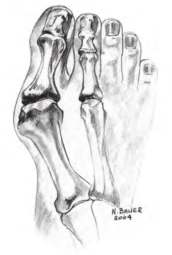 * Halgus Valgus or Small Bunion (Mild/ Moderate) joint