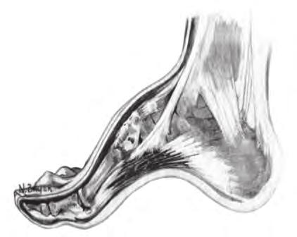 Pes Cavus (vs normal arch): In pes cavus, the arch is abnormally high on weight bearing. The heel is often tilted inwards at the ankle (but not always). In many, the toes will appear clawed.