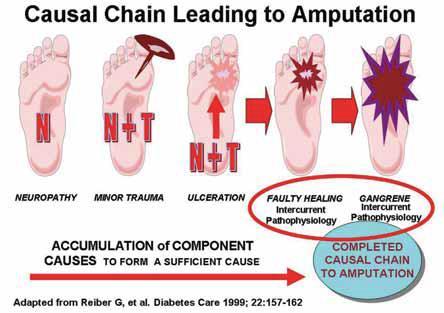 Figure 1: An illustration of the causal chain for developing a diabetic foot ulcer, as