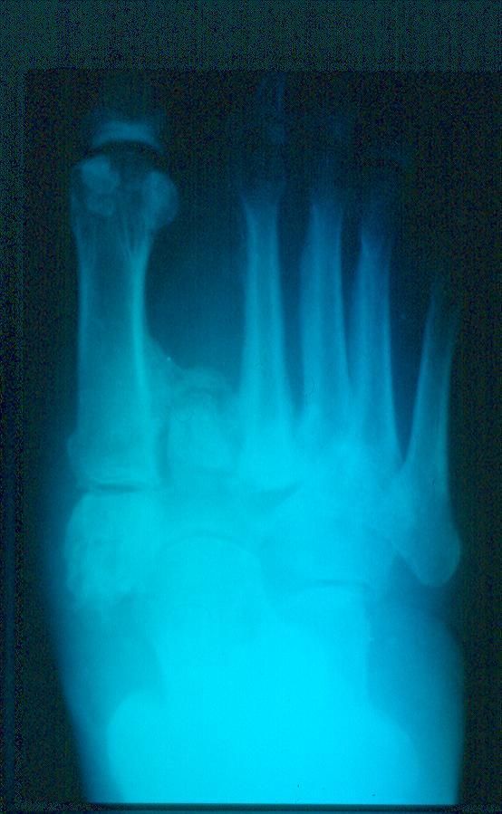 Stage III : Consolidation Clinical fixed deformity little swelling no redness or warmth X-ray