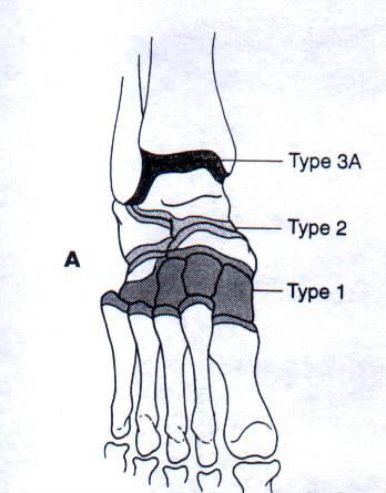 Anatomic(Radiographic) Classification