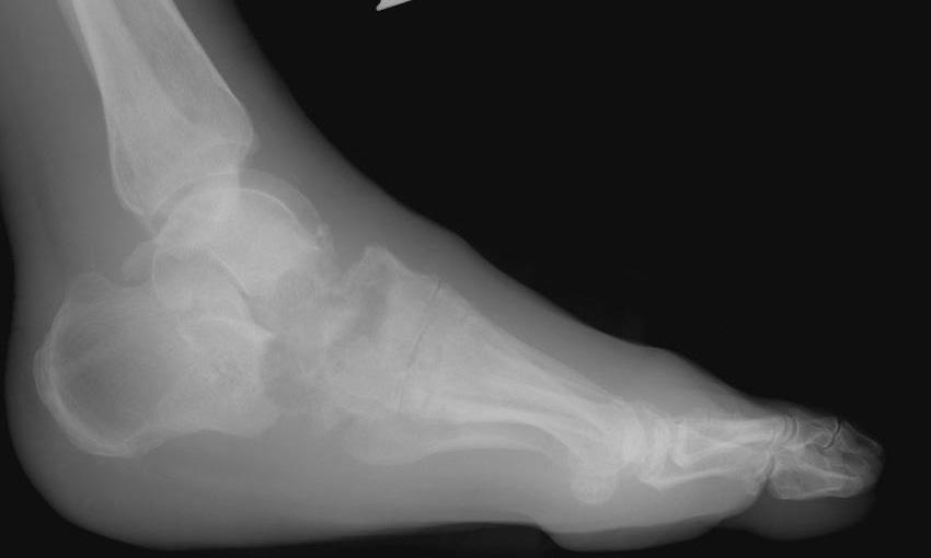 Hindfoot (type II) Clinical less common(20%)