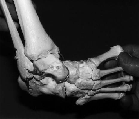 Model of clubfoot Talus & calcaneus : severe flexion Calcaneus, navicular, cuboid :