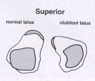 Main pathologic structure Talus