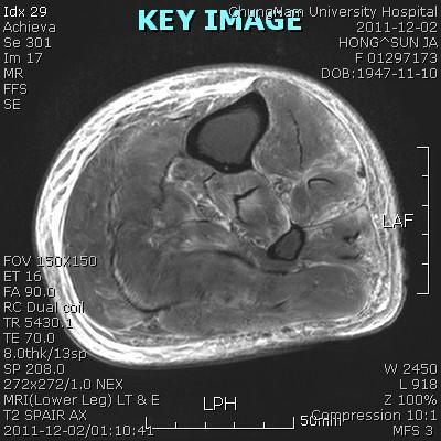 Case Presentation MRI CONCLUSION Lt.