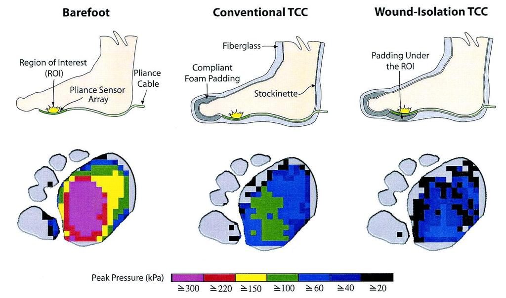 Concepts of TCC Decrease of pressure around the lesion by total contact Forefoot pressure distribute of approximately 30% to other region