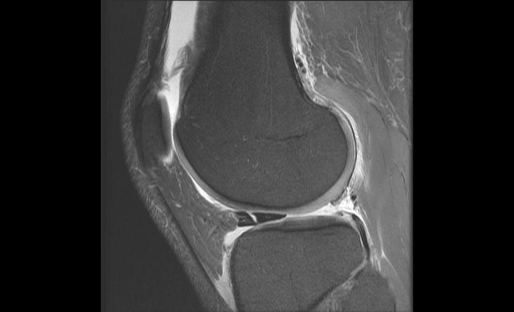 Meniscal Tear Role of Imaging What I report should include Location Type