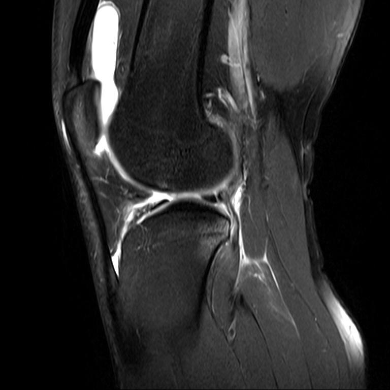 of lateral meniscus ACL